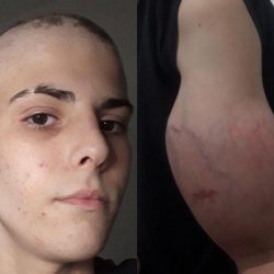 A teenager discovers cancer and will have to amputate his disfigured arm after doctors claim 'increasing pain' |  More health
