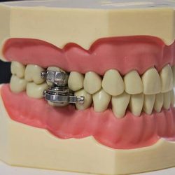 The university creates a device that almost prevents the mouth from opening