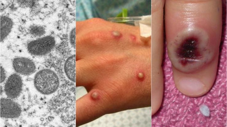 Symptoms that appear before skin blisters appear