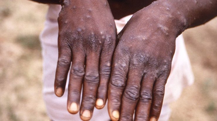 The government establishes a committee to monitor monkeypox cases