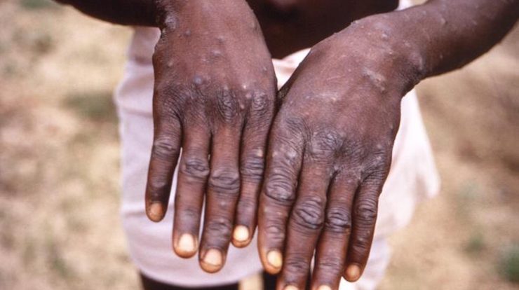 WHO says monkeypox poses 'moderate risk'