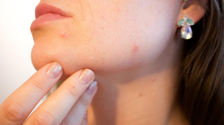 Why do pimples appear due to sweat and how can we prevent them?
