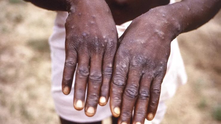 Urgent: Health confirms the first case of monkeypox in Acre