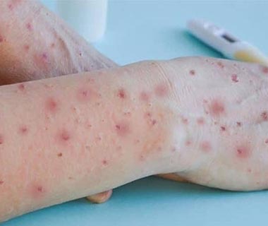 Four suspected monkeypox cases have been reported in Teresina, according to FMS