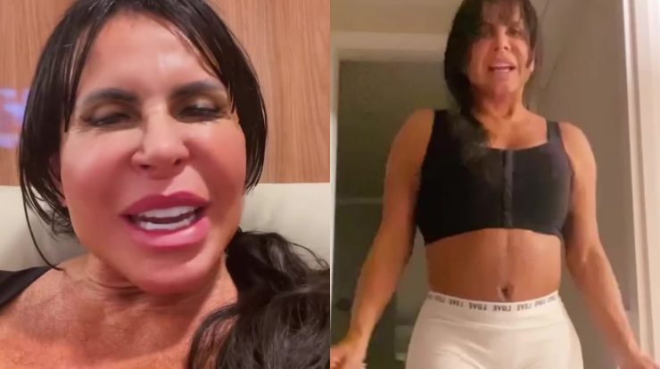 Gretchen shows her body six days after plastic surgery and the result is amazing
