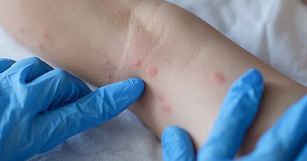Salvador confirms another case of monkeypox;  The total number of cases in Bahia is 13